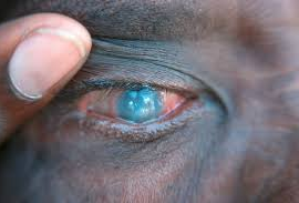  À l'occasion de la Semaine mondiale de lutte contre le glaucome, du 23 au 27 mars, l'Hôpital général de Douala ouvre ses portes pour une campagne de dépistage gratuit.